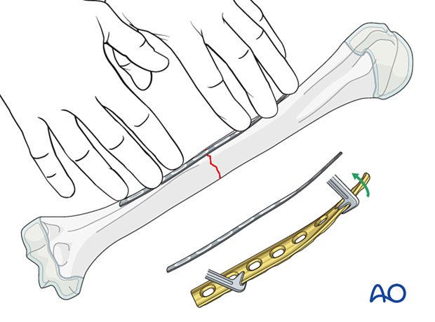 Compression plating of pediatric humeral shaft fracture, with DCP contoured and overbent for compression.