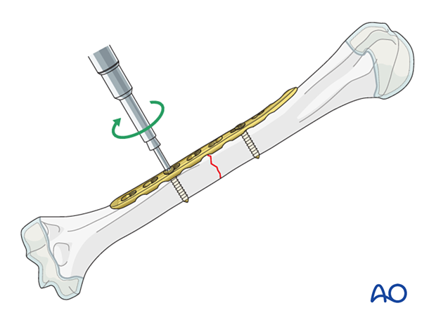 Compression plating of pediatric humeral shaft fracture, applying plate standardly while avoiding periosteal stripping.