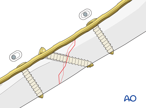 Compression plating of pediatric humeral shaft fracture, with plate positioned for optimal lag screw fixation.