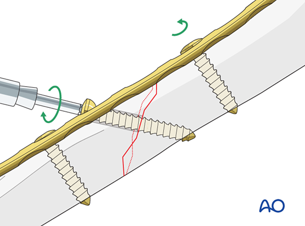 Compression plating of pediatric humeral shaft fracture, with lag screw fixation steps and retightening procedure.