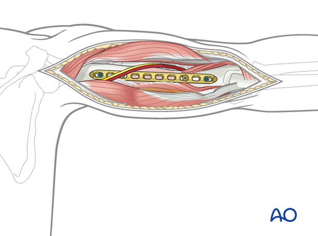 Bridge plating for pediatric humeral shaft fractures: posterior plate preferred for middle/distal third.