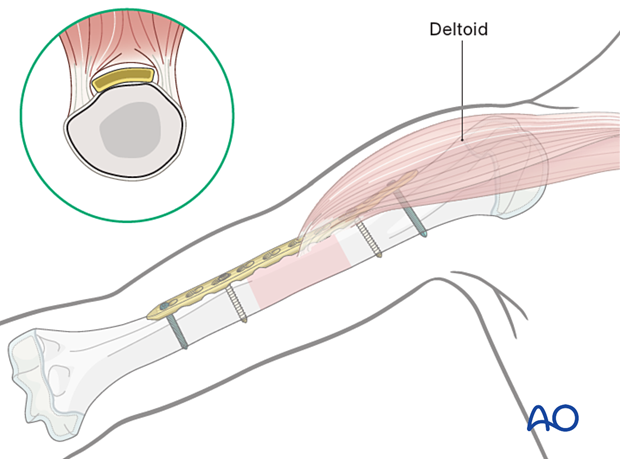 Bridge plating for pediatric humeral shaft fractures: anterolateral plate for proximal/middle third.