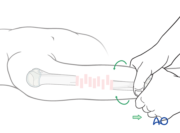 Bridge plating for pediatric humeral shaft fractures: traction for length, avoid direct reduction, plate as aid