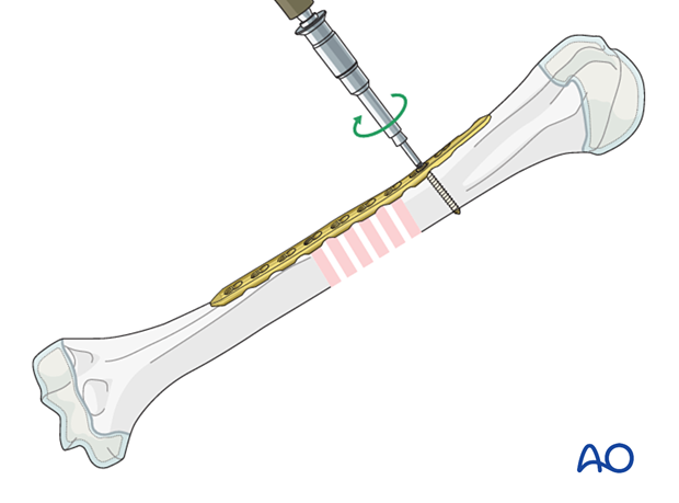Bridge plating for pediatric humeral shaft fractures: avoid periosteal stripping, attach plate with bicortical screw.