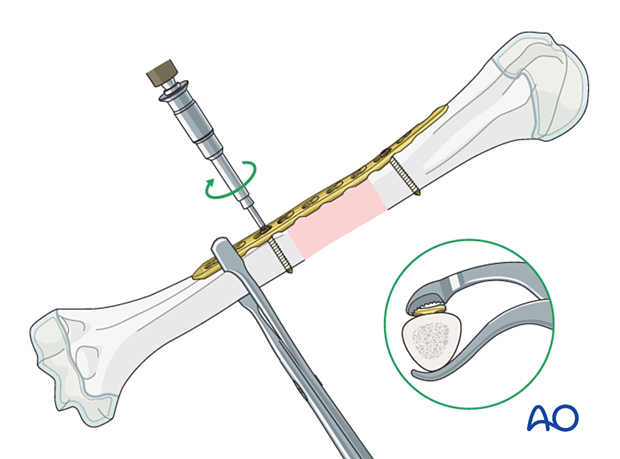 Bridge plating for pediatric humeral shaft fractures: check alignment, insert second cortical screw distally.