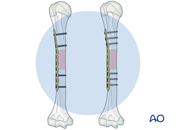 Bridge plating for pediatric humeral shaft fractures: add screws, confirm alignment, reduction, and rotational alignment.