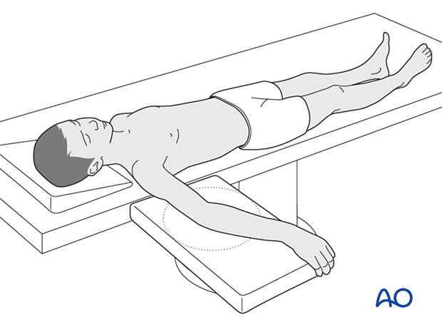 Supine position with arm on radiolucent board for anterior and anterolateral humeral shaft approaches.