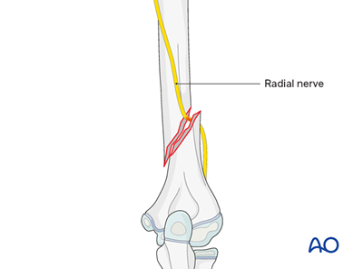 Management of associated radial nerve injuries