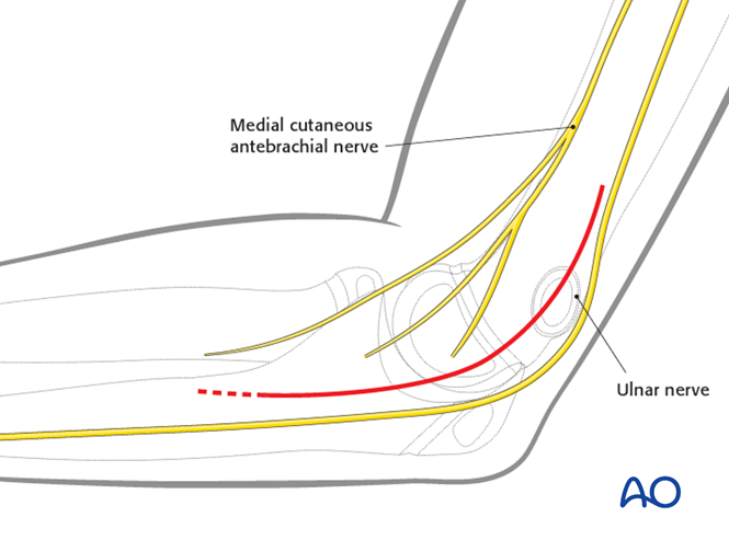 Medial approach to the pediatric distal humerus