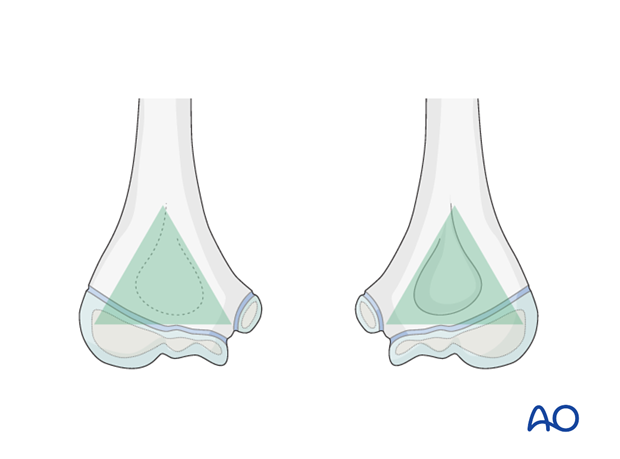 distal humerus anatomy