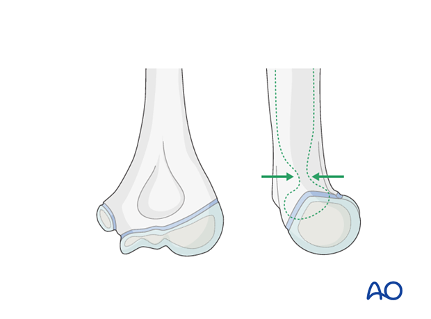 distal humeral surgical and developmental anatomy
