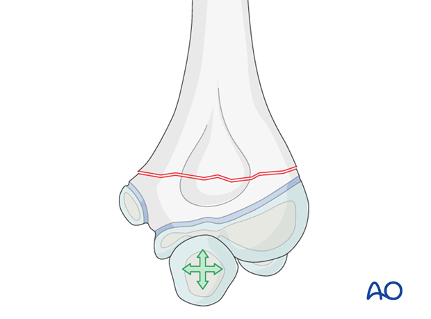 closed reduction k wire fixation