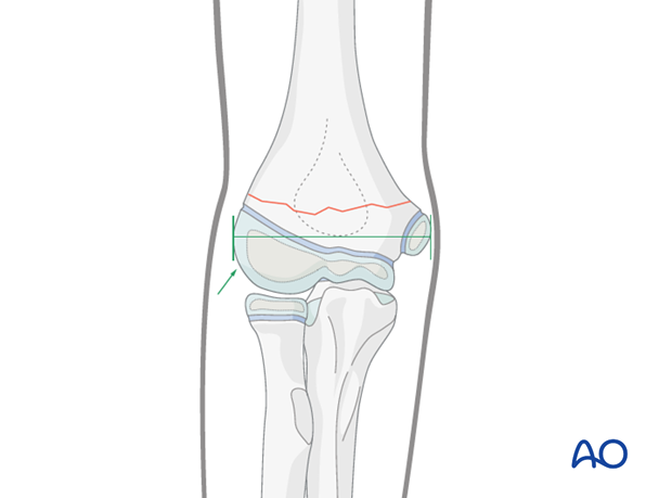 closed reduction k wire fixation