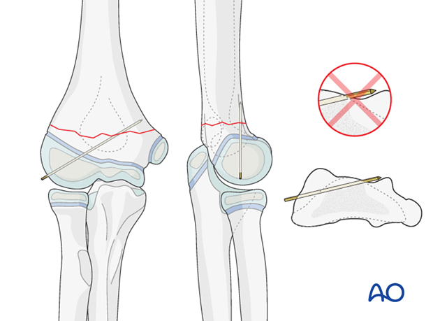 closed reduction k wire fixation