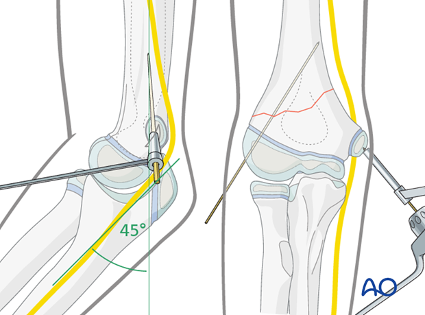 closed reduction k wire fixation