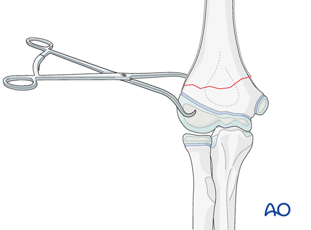 open reduction k wire fixation