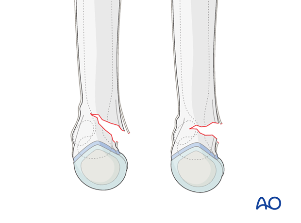 closed reduction k wire fixation