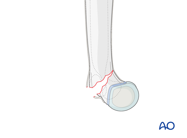 closed reduction k wire fixation