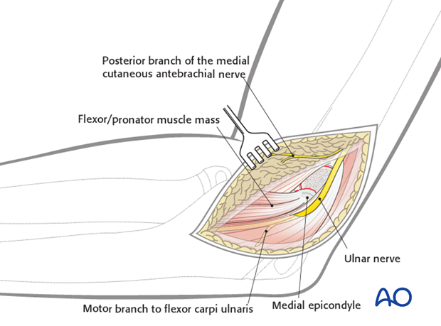 open medial epicondylar reduction and internal fixation