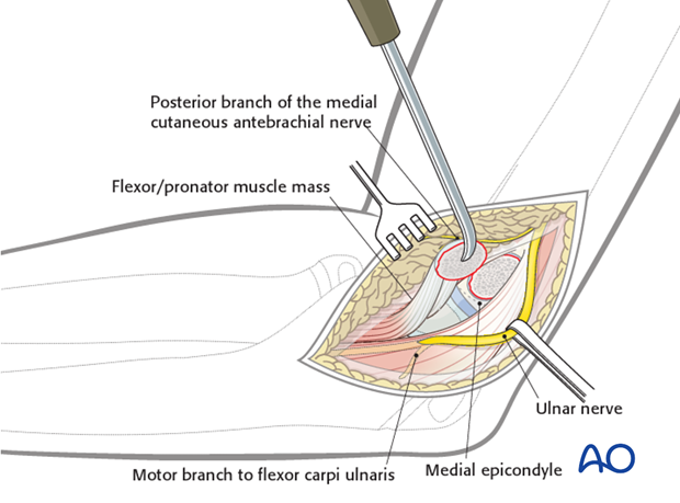 open medial epicondylar reduction and internal fixation