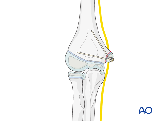 open medial epicondylar reduction and internal fixation