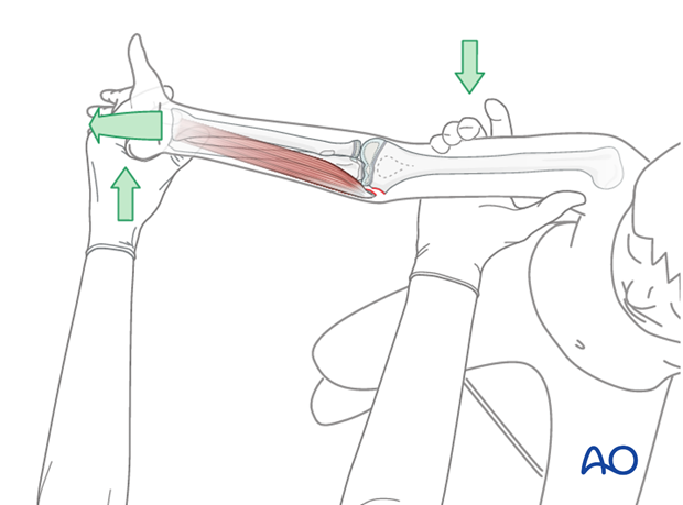 closed elbow reduction splint immobilization