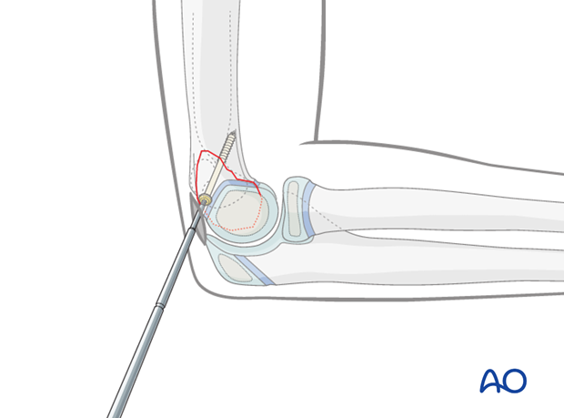 minimally invasive cannulated screw fixation