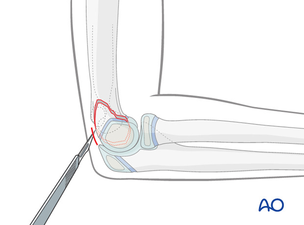 minimally invasive cannulated screw fixation