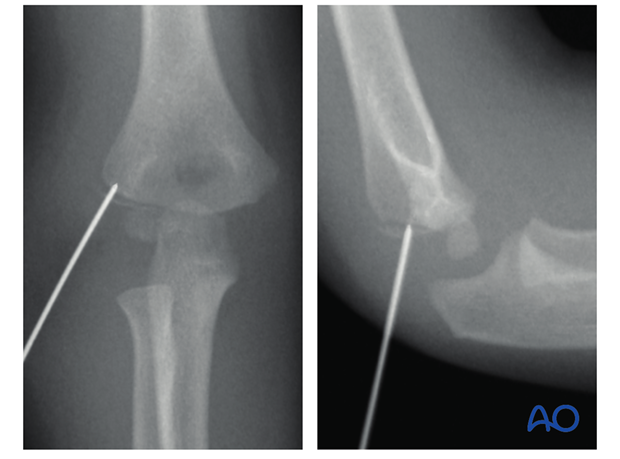 minimally invasive cannulated screw fixation