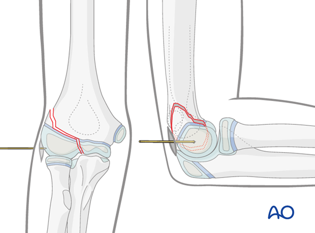 closed indirect reduction k wire fixation