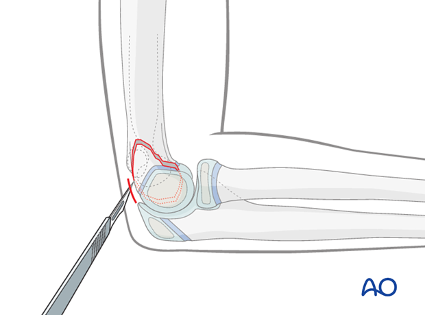 closed indirect reduction k wire fixation