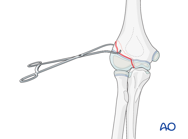 open reduction screw fixation