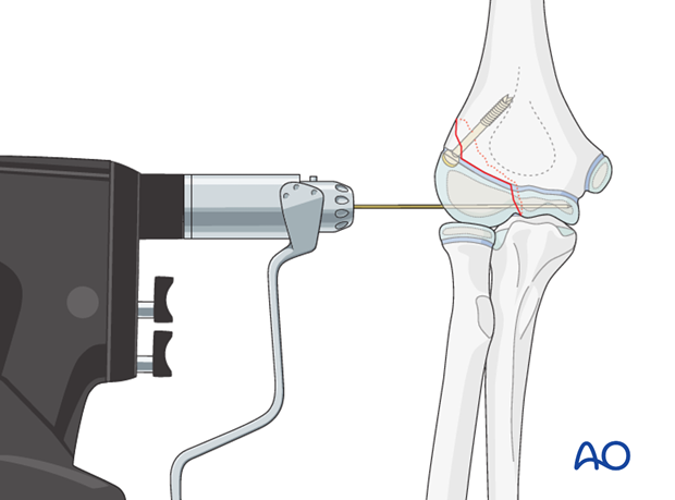 open reduction screw fixation