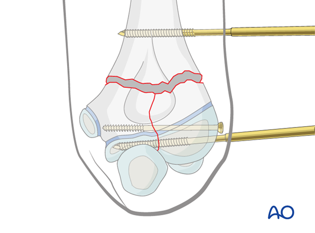 open reduction screw and external fixator