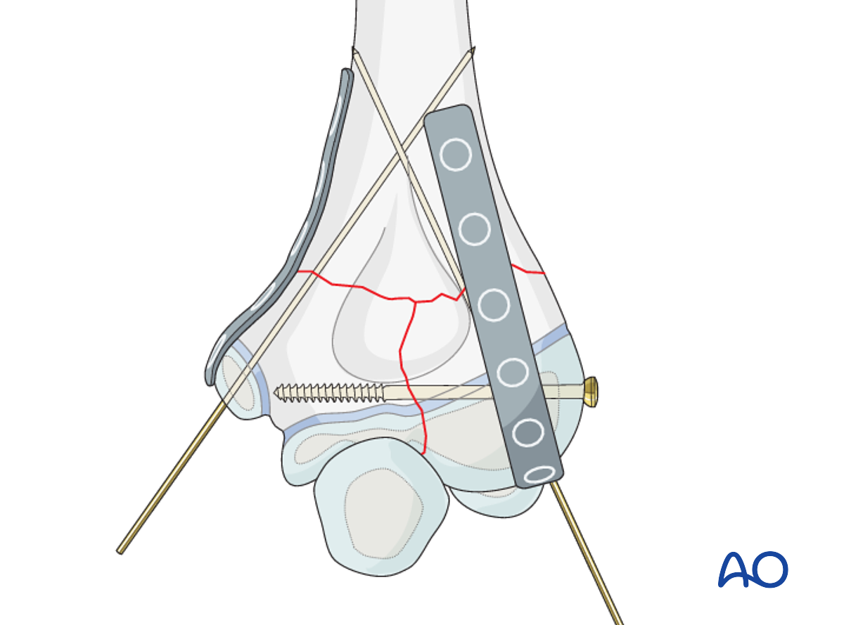 Open Reduction; Screw And Plate Fixation For Multifragmentary Epi ...