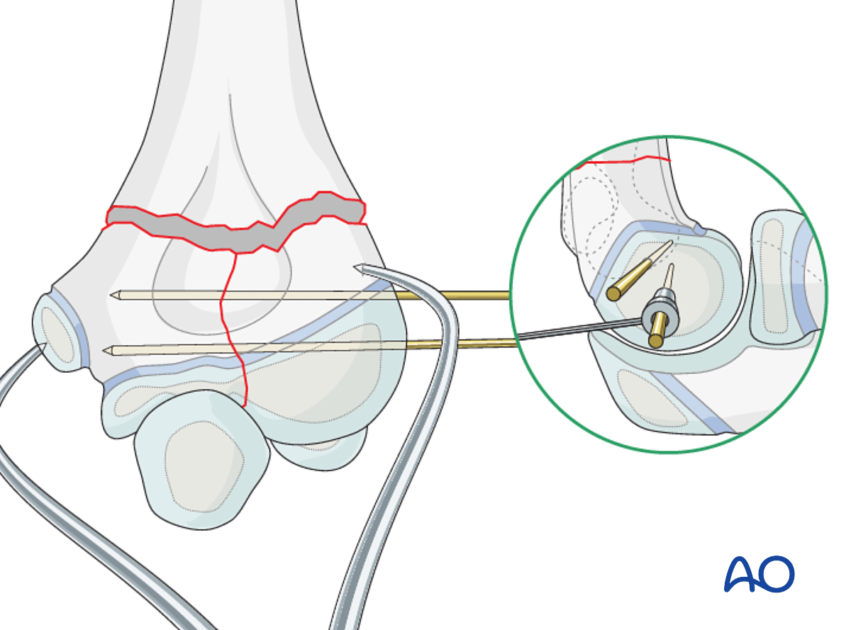 Open Reduction; Screw And Plate Fixation For Multifragmentary Epi ...