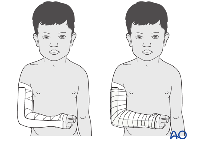 Splint immobilization for Simple epiphysiolysis, SH I