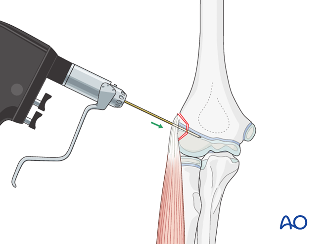 Open reduction; K-wire fixation for Avulsion of/by the lateral ...