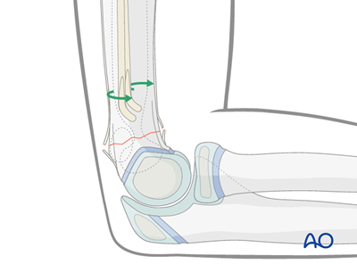 ESIN for Simple metaphyseal, complete with/without contact between ...