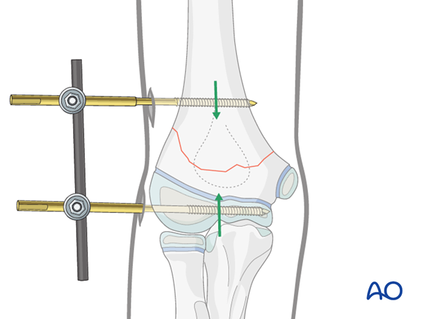 external fixator