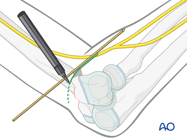 external fixator