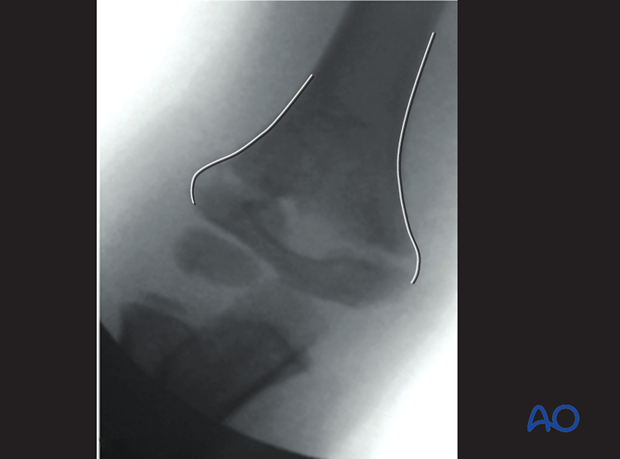 closed reduction of supracondylar fractures