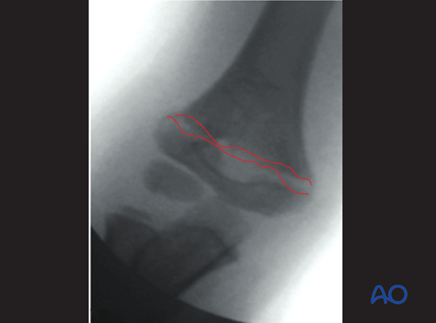 closed reduction of supracondylar fractures