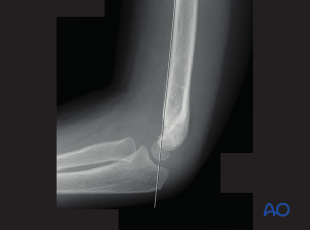 closed reduction of supracondylar fractures