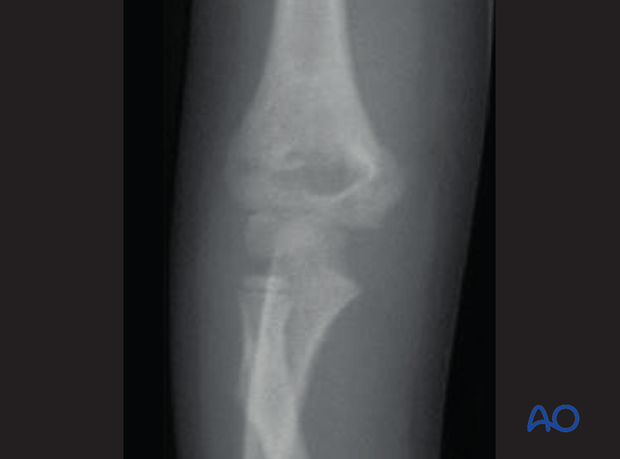 closed reduction of supracondylar fractures