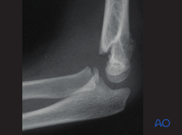 closed reduction of supracondylar fractures