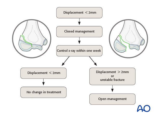 treatment algorithm for intraarticular fractures of the distal humerus