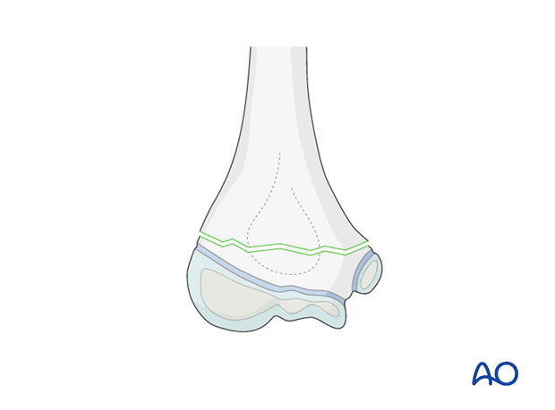 timing of treatment of fractures of the distal humerus