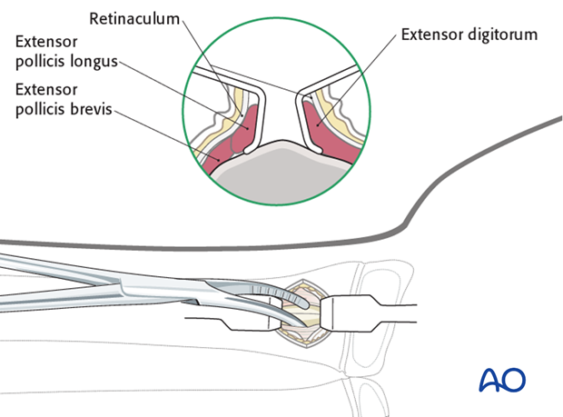 ESIN - Dorsal (Lister’s tubercle) entry point to the radius