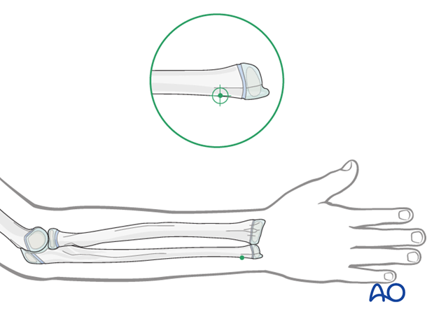 ESIN - Entry point to the ulna